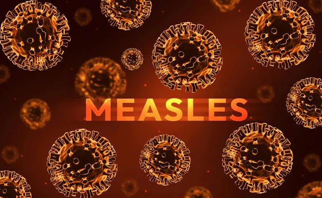 6aaaba7a26d361f9e2d9694c Measles 2